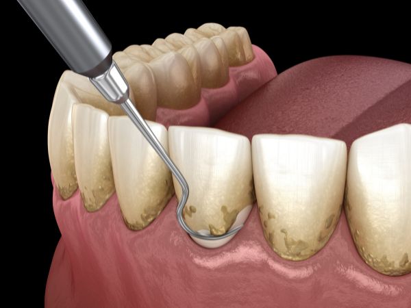 Periodontal Treatment