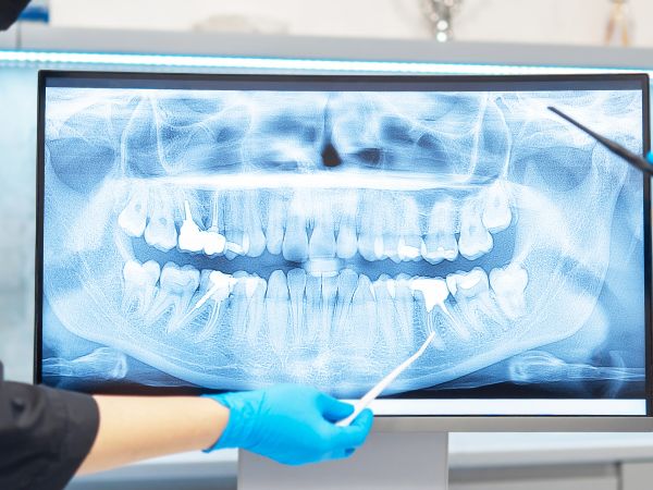 Dental X-RaysSandpoint